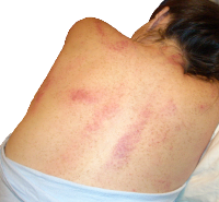 Gua sha marks on back of female patient